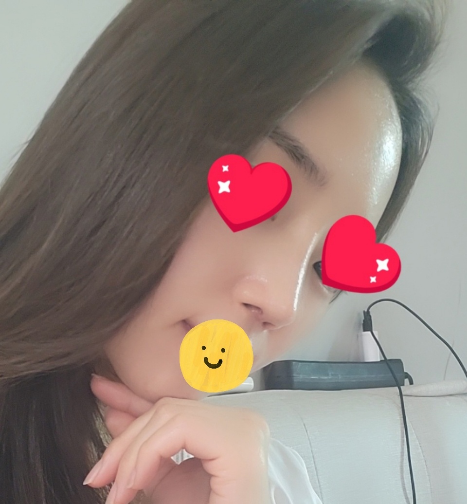 코재수술, 얼굴지방흡입 3주차