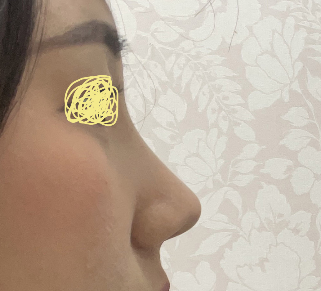 무보형물코성형 후기입니다><