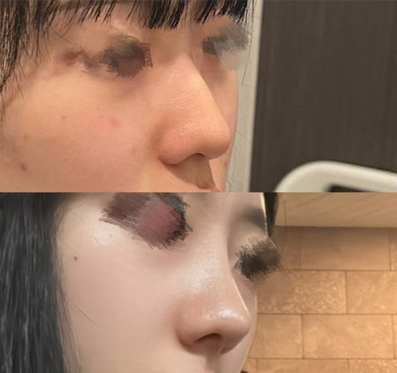 매부리코/눈트임했어요~