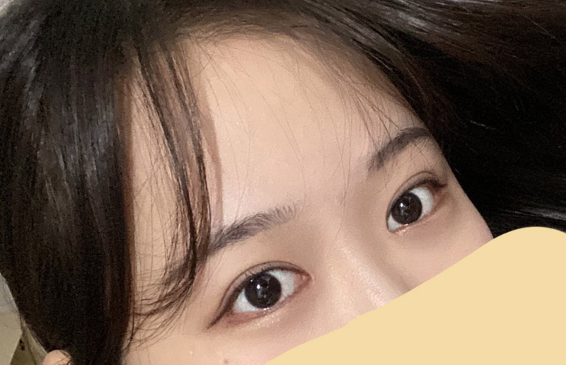 넘나 만족스러운 수술입니당!