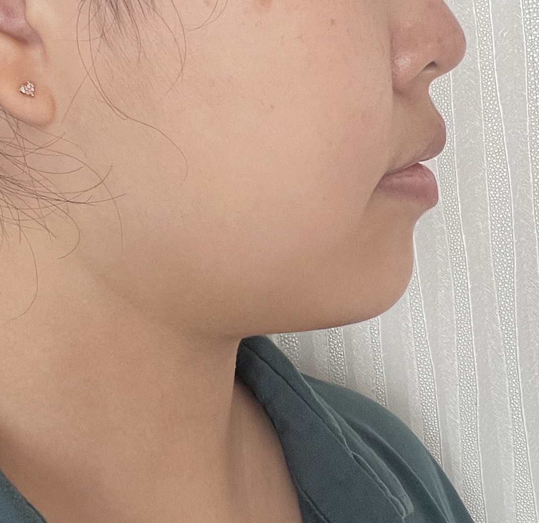 턱살고민이신 분들 끝장지흡강추용~