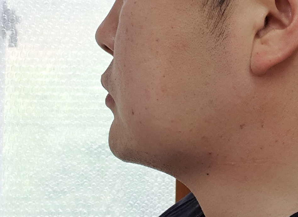 받았던 시술들보다 지방흡입이 효과좋네요