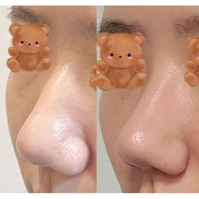 기능코수술 대대만족쓰