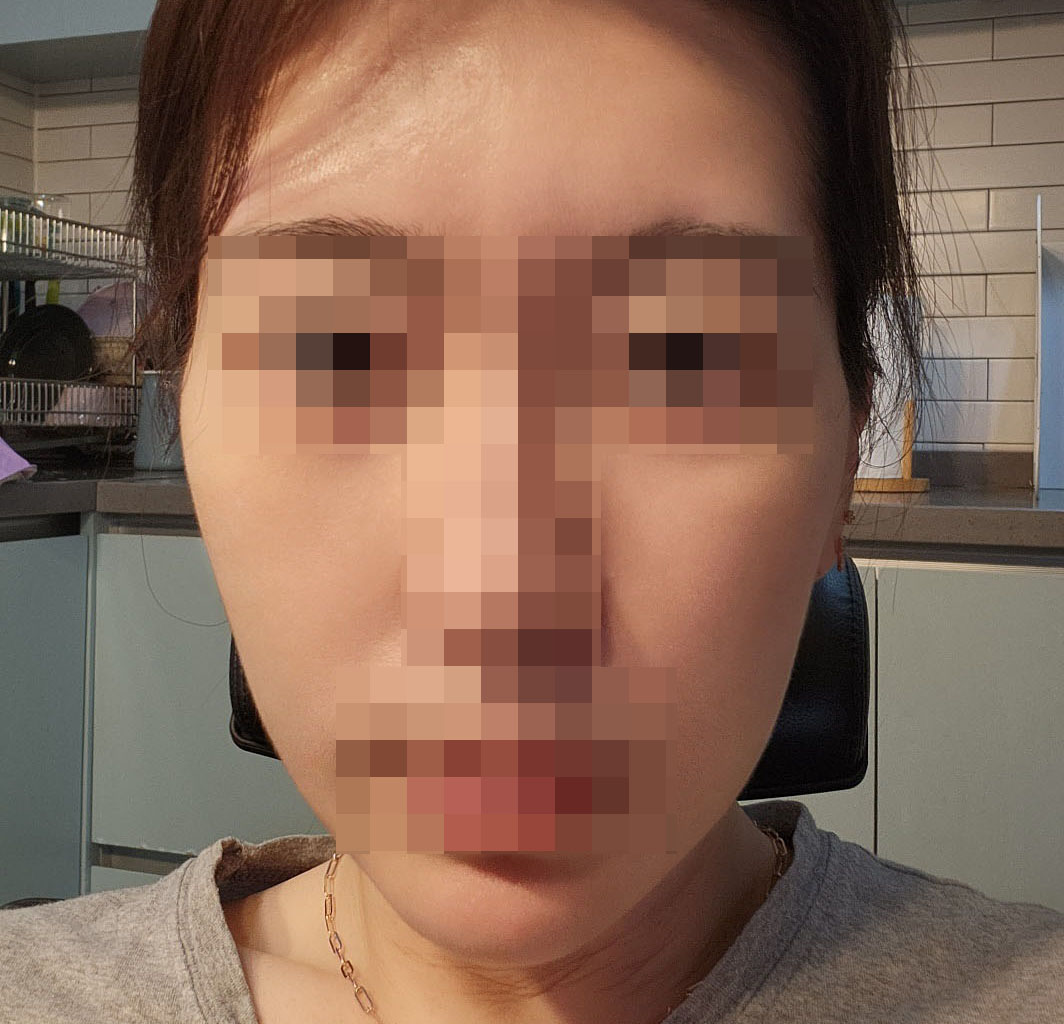 원장님 믿고 이번엔 안면거상했습니다.