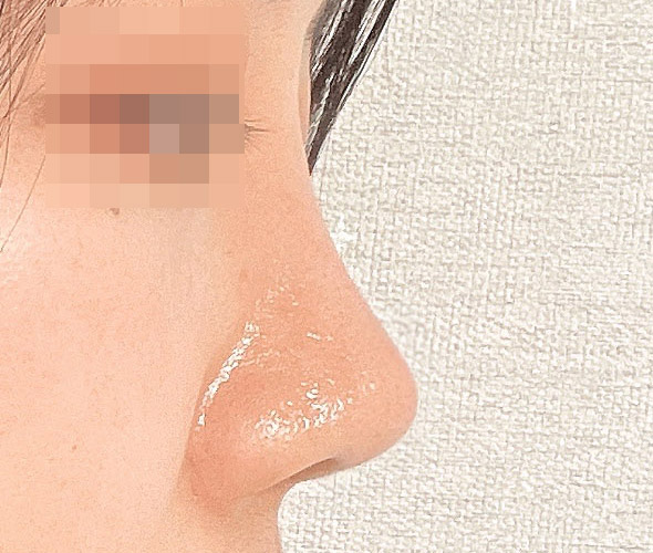 들창코수술 이번엔 만족해요!