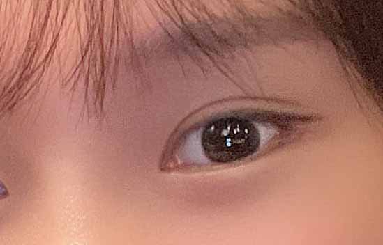 자연유착 재수술 + 망고트임(뒤트임,밑트임) + 윗트임 후기