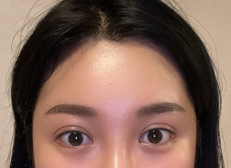 내시경이마거상+부분절개눈매교정+얼굴지방흡입