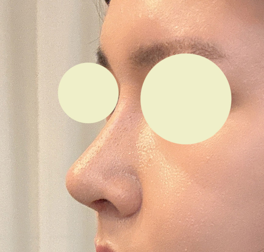 매부리코수술 성공후기올립니다!