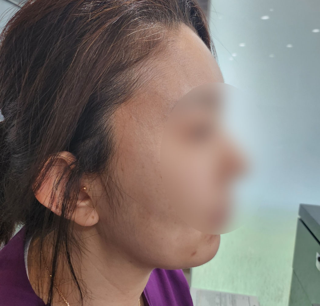 지방이식, 지방흡입수술!바이브 선택 후회없네요^^