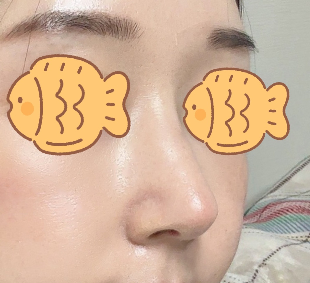 컴플렉스도 개선되고 코모양만족!!