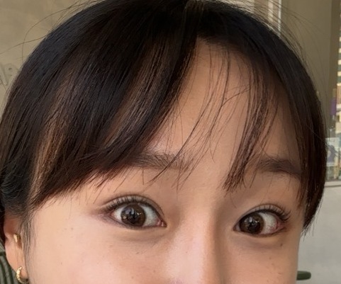 내시경이마거상술+눈트임수술 7개월차