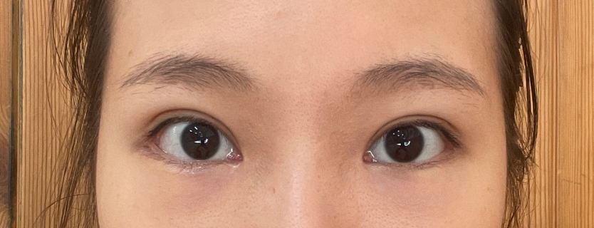 쌍수재수술 3주~~