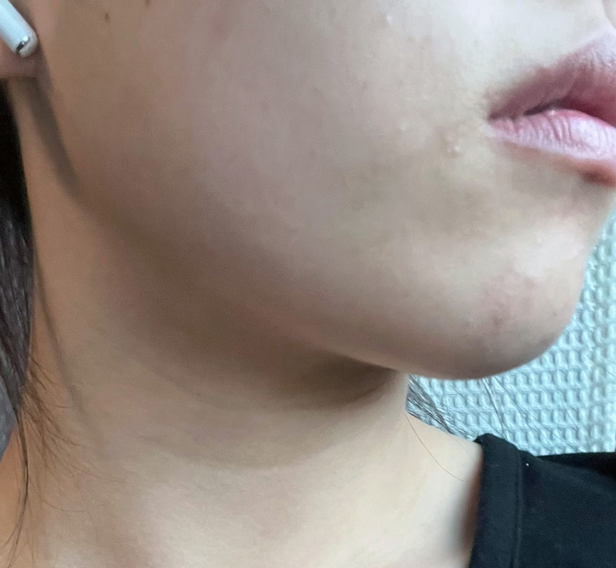 빠지지 않던 투턱ㅠ지흡으로 뿌셨습니다!