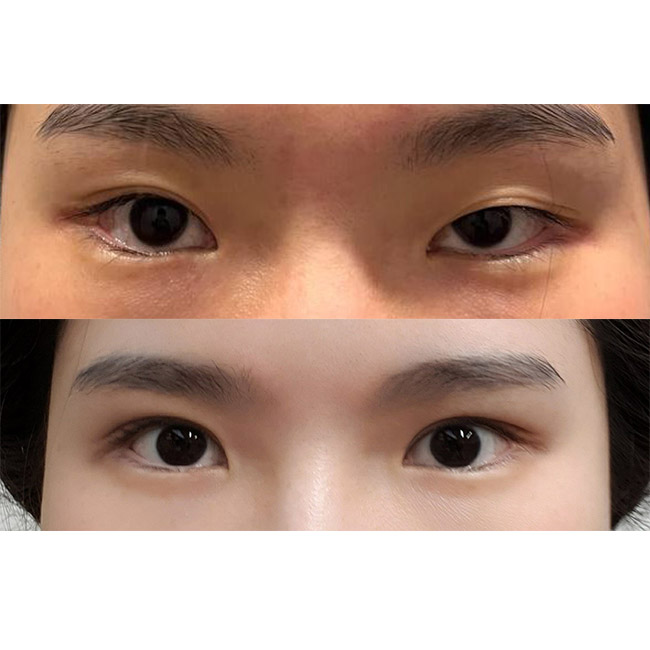 쌍꺼풀풀려서 다시 절개눈매교정해써요