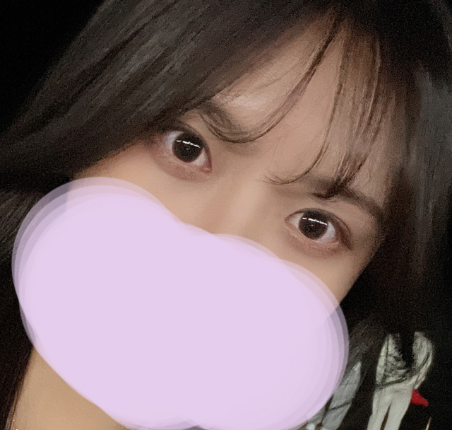 겹쌍꺼풀 교정 잘 됐습니닷