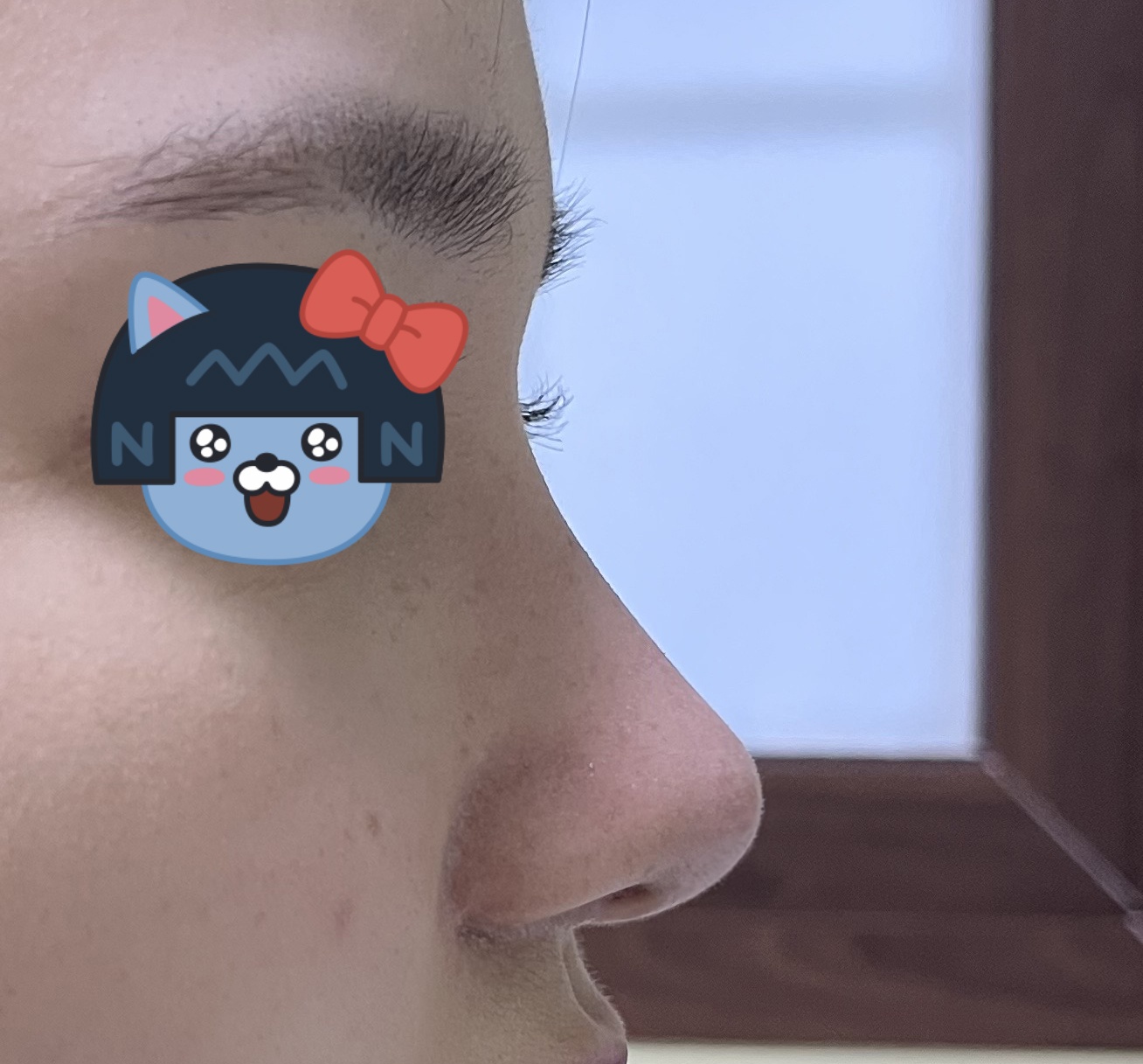 낮은코, 복코성형 대성공!