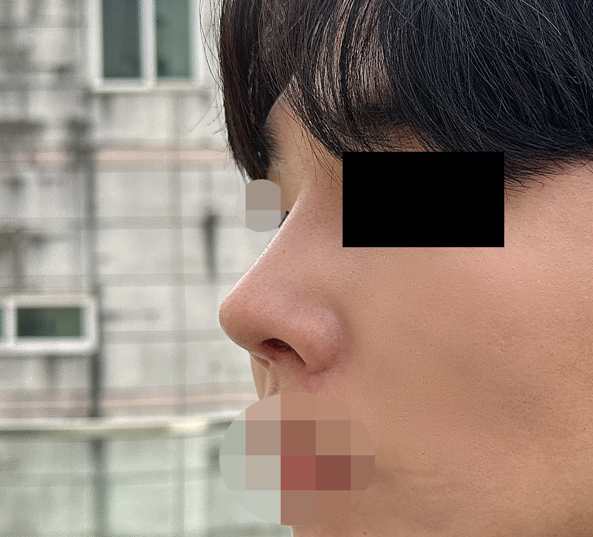 남자코수술 후회없는 선택입니다:)