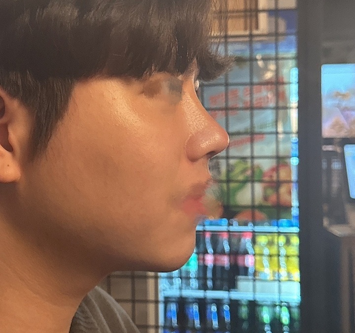 남자코수술&지방흡입&심부볼제거후기요!