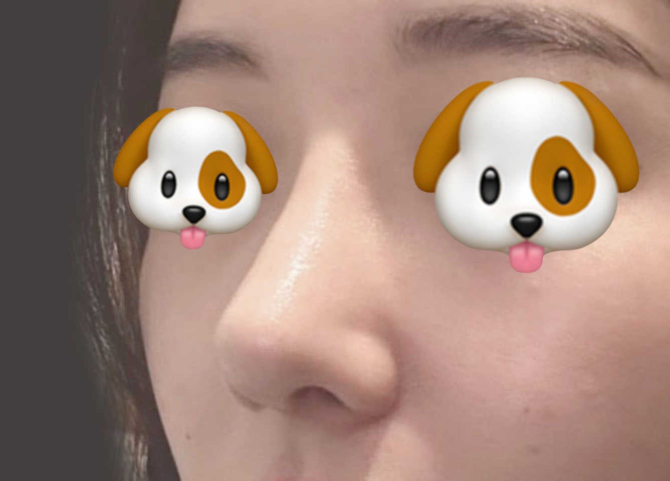 매부리코교정, 휜코교정 제대로 됐어요:)