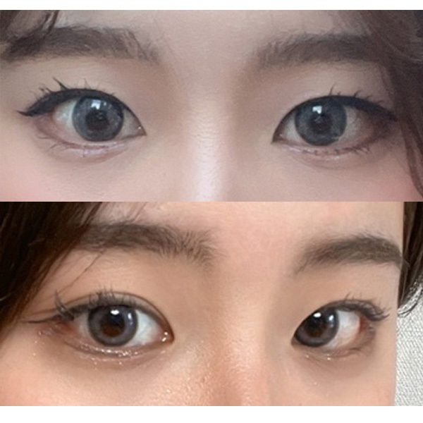 망고트임 4개월이 지났어요!