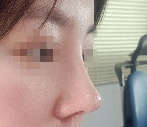 수술잘돼서 후기씁니당^^