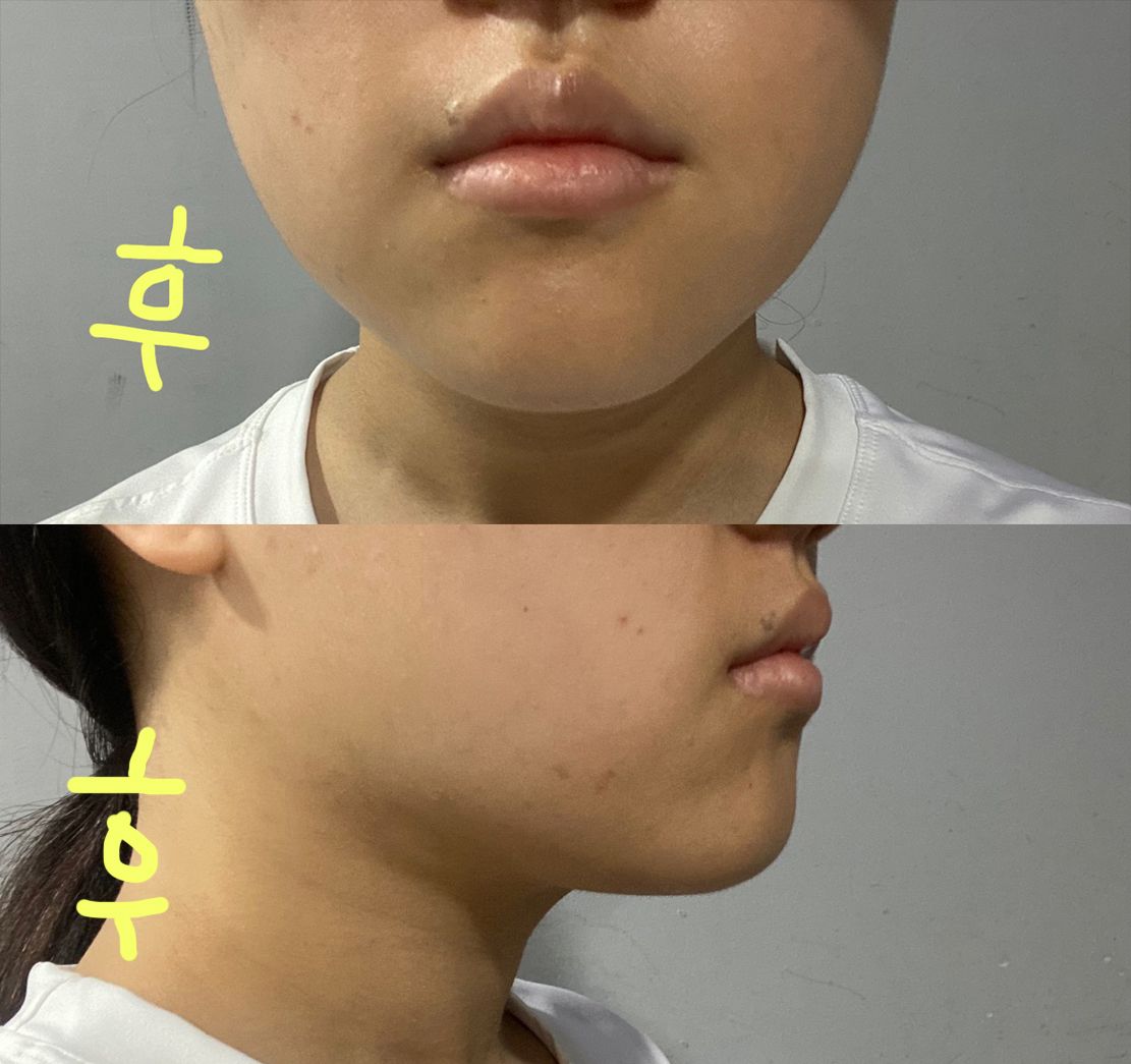 이중턱, 턱라인 지방흡입받았슴니돵