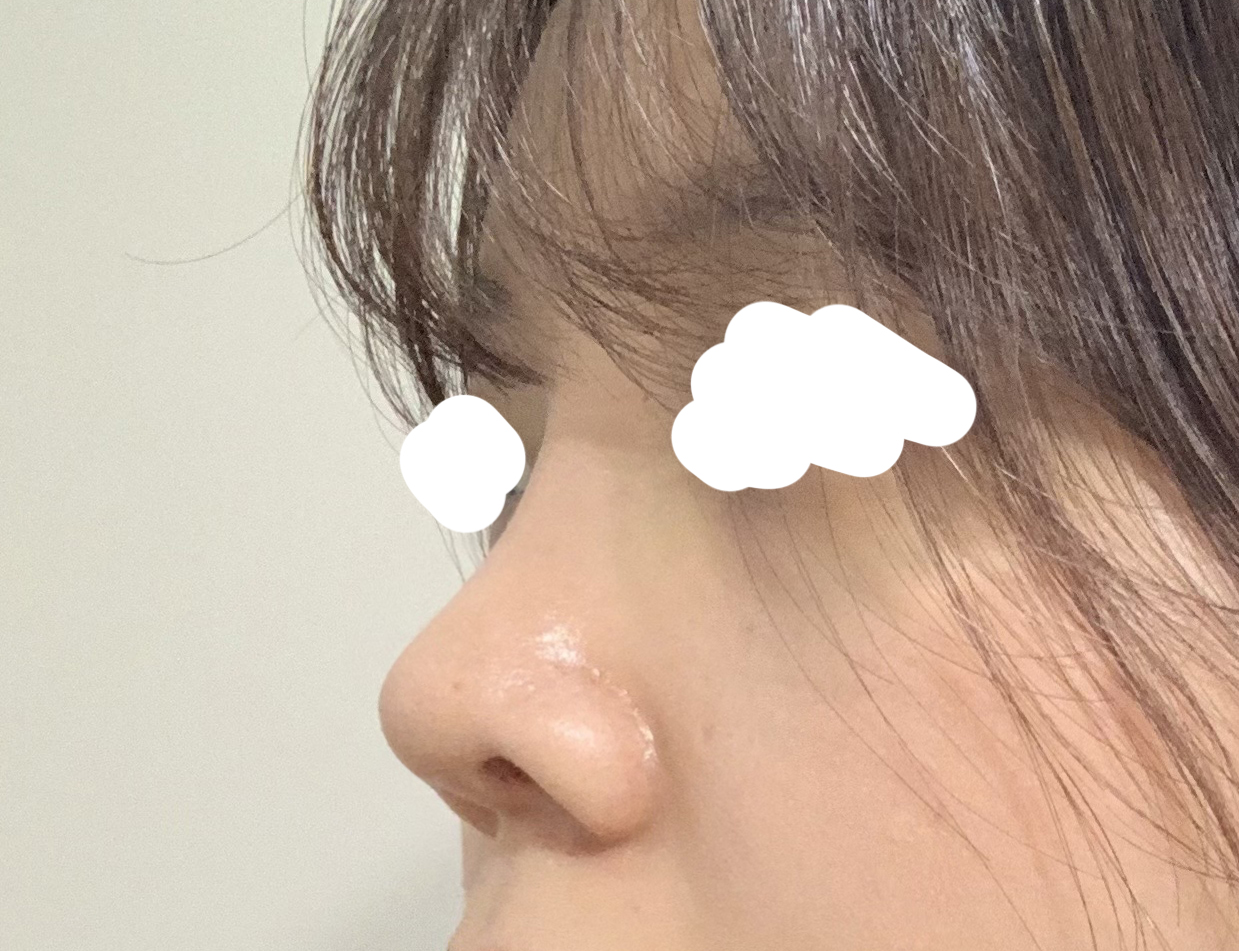 낮고 짧은코성형 후기