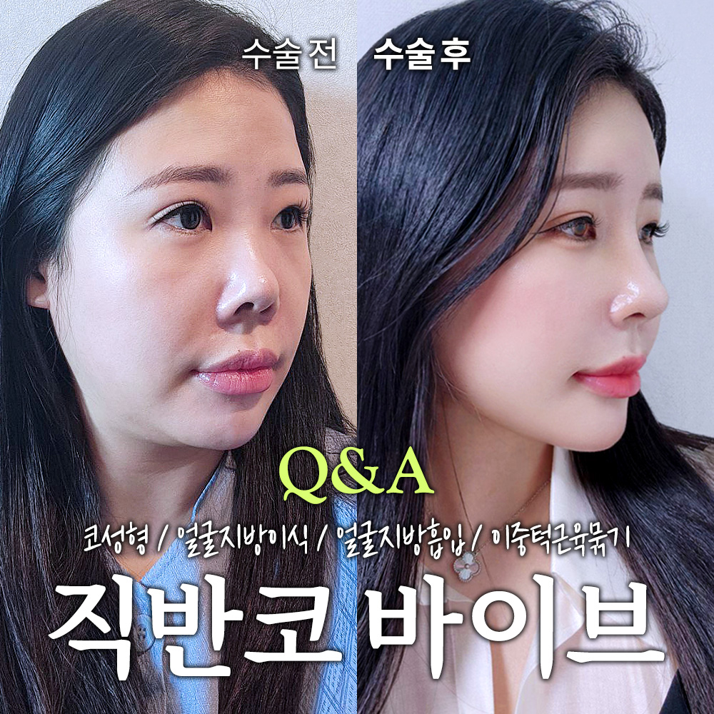 [VLOG] 7주 차까지 꽉 채운 코수술 후기! (전후 비교 / 코성형 Q&A / 붓기, 멍 관리 / 직장인 성형)