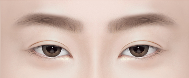 안검하수 교정이 되지 않은 눈