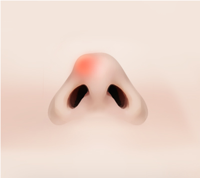 보형물이 만져지는 경우